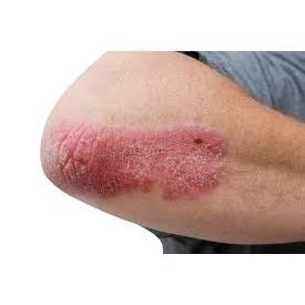 MG217 PSORIASIS MEDICATED MOISTURIZING CREAM &amp; MULTI SYMPTOM OINTMENT